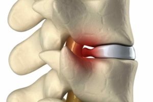 hernia discal