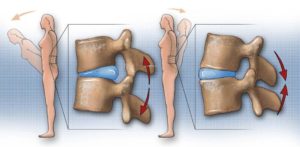 hernia discal