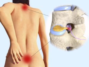 hernia discal